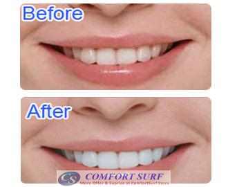 White Light Tooth Whitening